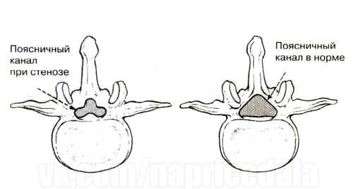 Остеохондроз: Жалеть или закачивать спину? 02 Остеохондроз: Жалеть или закачивать спину? 02