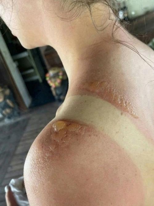 В Петербурге студентка сильно обгорела на солнце. 02