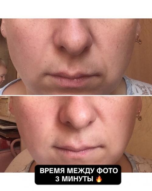 Откуда берутся носогубные складки, и как с ними бороться? 03 Откуда берутся носогубные складки, и как с ними бороться? 03