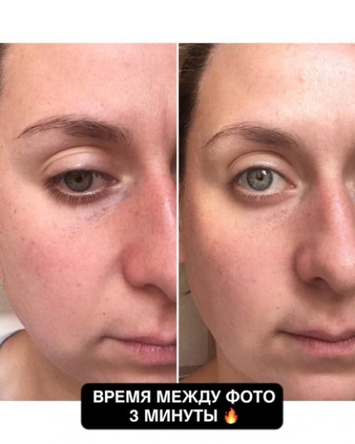 Откуда берутся носогубные складки, и как с ними бороться? 02 Откуда берутся носогубные складки, и как с ними бороться? 02