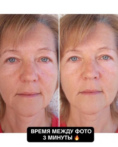 Откуда берутся носогубные складки, и как с ними бороться? 04 Откуда берутся носогубные складки, и как с ними бороться? 04