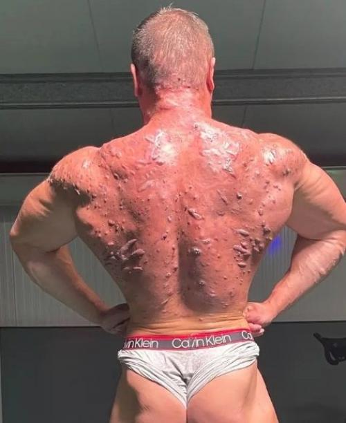 Бодибилдер продемонстрировал серьезный вред, нанесенный его телу стероидами. 01 Бодибилдер продемонстрировал серьезный вред, нанесенный его телу стероидами. 01