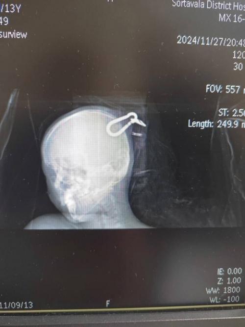 Карельские врачи спасли подростка, которому крепежный карабин вошел в мозг. 01