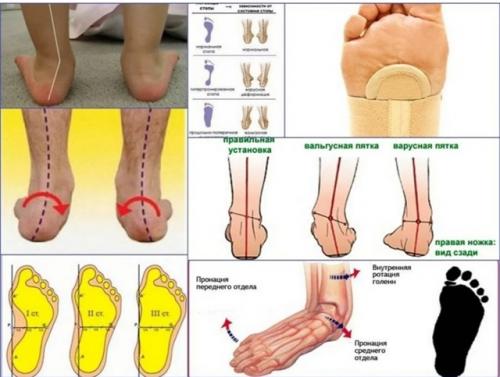 Почему у человека с вальгусом и плоскостопием очень часто болят ноги, стопы и голени? 01 Почему у человека с вальгусом и плоскостопием очень часто болят ноги, стопы и голени? 01