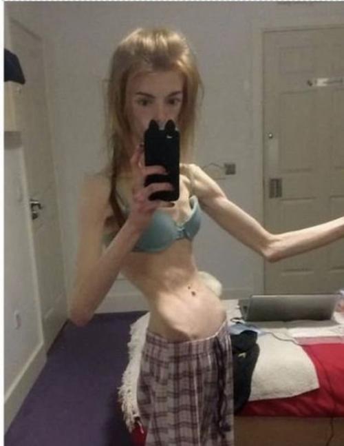 Эта прекрасная девушка смогла победить страшную анорексию и встретила свою любовь. 02