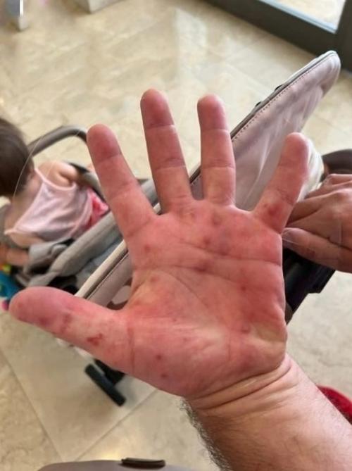 Новый вирус тяжёлые симптомы вызывает. 01