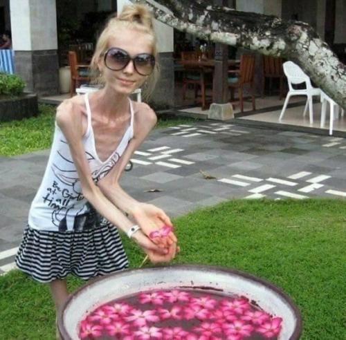 Эта девушка смогла победить анорексию! 01