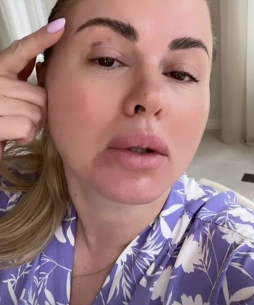 Анна Семенович шокировала подписчиков новым видео - под глазом певицы явно виднелся кровоподтёк.  