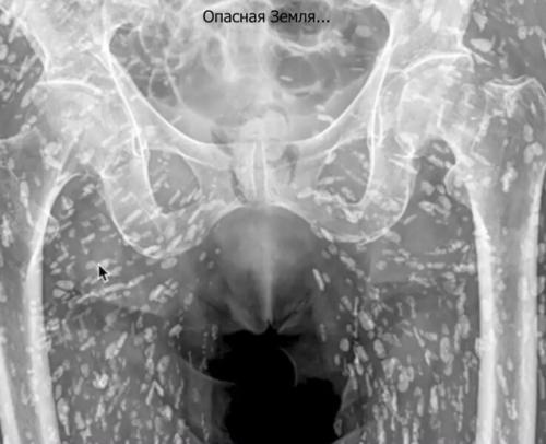 Врач во время рентгена нашел сотни яиц ленточного червя в теле пациента.

