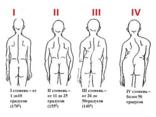 Наболевшая тема - боли в спине, сколиоз, остеохондроз? 02 Наболевшая тема - боли в спине, сколиоз, остеохондроз? 02