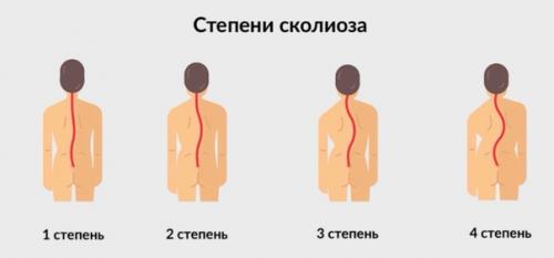 Наболевшая тема - боли в спине, сколиоз, остеохондроз? 03 Наболевшая тема - боли в спине, сколиоз, остеохондроз? 03