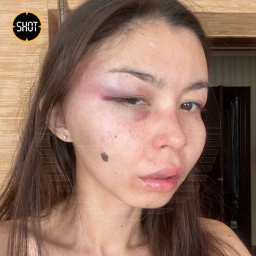 Пьяный стpиптизeр жeстоко изуродовал лицо своей жены в Республике Xакaсия. 05