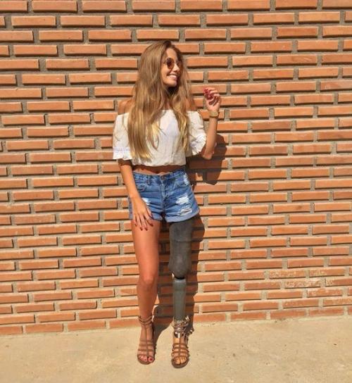 Девушка, потеряв ногу, нашла в себе силы жить дальше и радоваться каждой минуте! 01