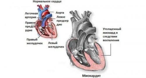 Двухсторонняя полисегментарная пневмония у взрослого сроки выздоровления. Двусторонняя полисегментарная пневмония у взрослых – причины внебольничной