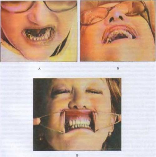 Гипертрофия жевательных мышц. Лечение больных с гипертрофией жевательных мышц