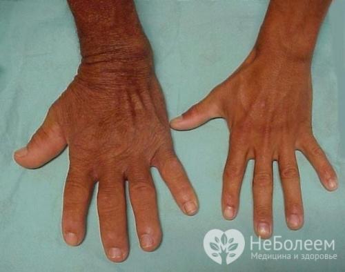 Как повысить выработку гормона роста естественным путем. Повышенный уровень соматотропина