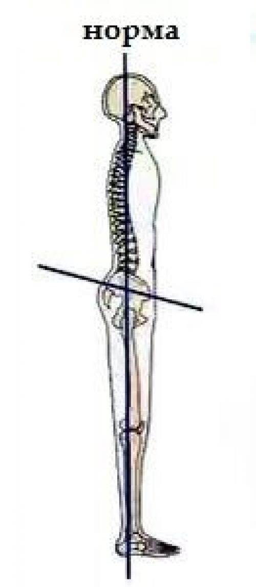 Наклон таза вперед. Что такое передний наклон таза