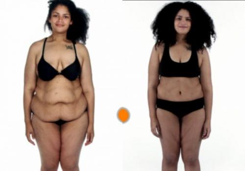 Как подтянуть обвисшую кожу. Профилактика обвисания кожи при похудении