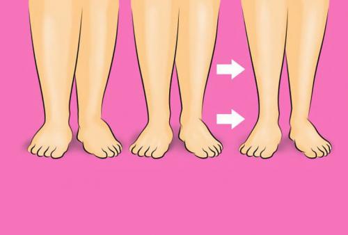 Задержка жидкости в организме: симптомы , которые вы не должны игнорировать