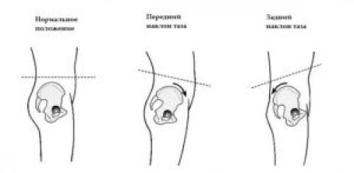 Наклон таза вперед. Что такое передний наклон таза