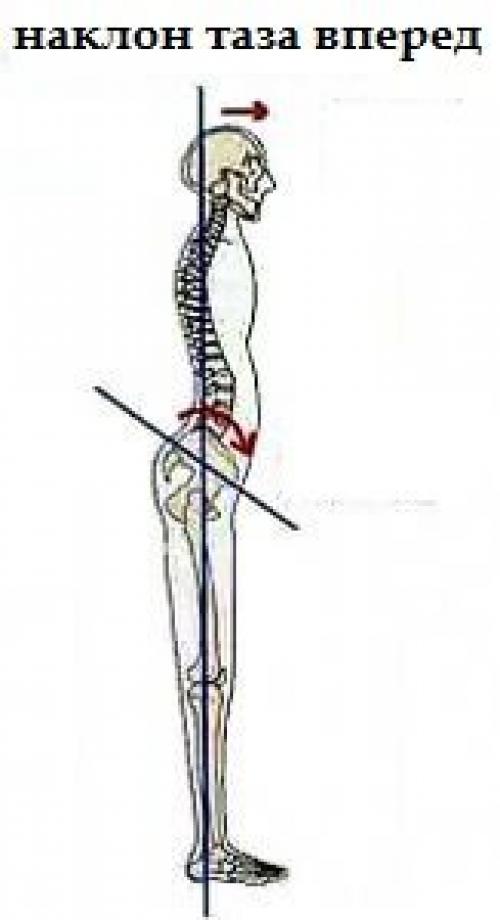 Наклон таза вперед. Что такое передний наклон таза