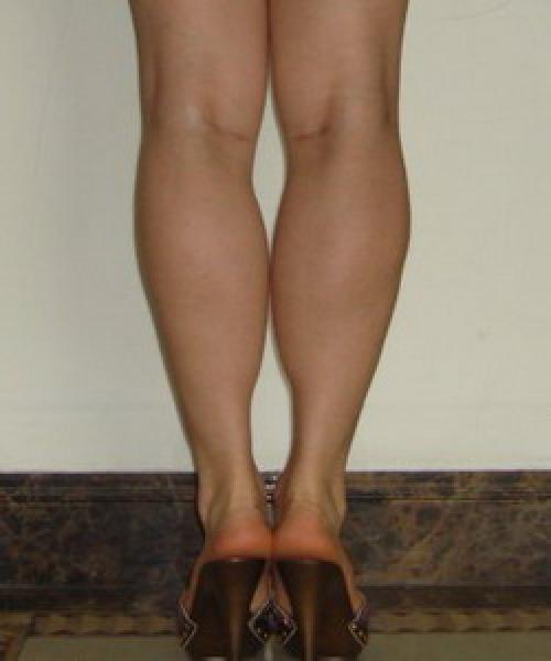 Как сделать икры ног тоньше в кратчайший срок. Почему полнеют икры