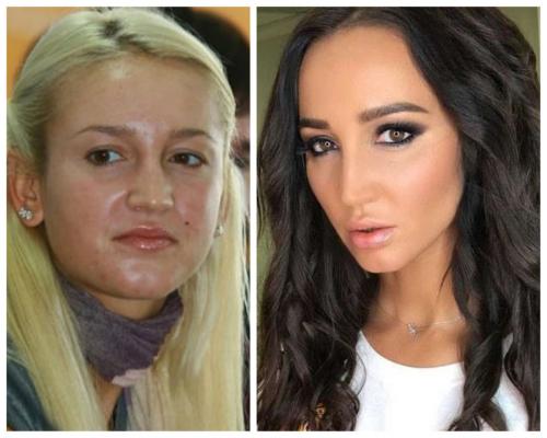 Ольга бузова до пластики. До и после пластики: Шейк, Боня, Хилькевич, Бузова, Брежнева и другие
