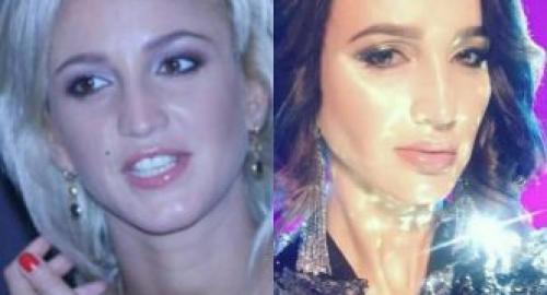 Ольга Бузова до пластики. Ольга Бузова до и после пластики