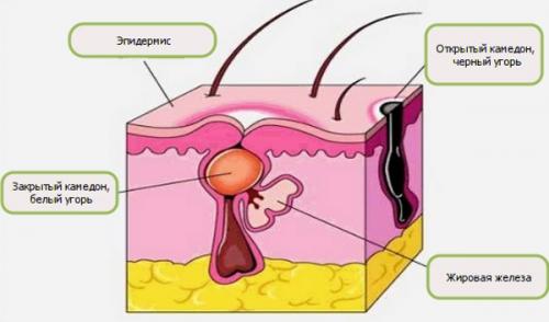 Почему с возрастом увеличиваются поры на лице. Как бороться с расширенными порами на лице