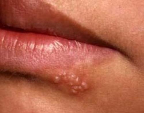 Есть ли прививка от герпеса. Вакцина от герпеса