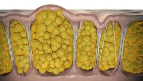 Порядок борьбы с целлюлитом. Почему появляется целлюлит