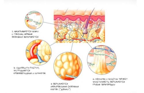 Порядок борьбы с целлюлитом. Почему появляется целлюлит