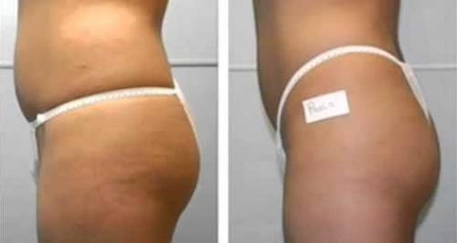 Процедуры для похудения в салоне. Показания и противопоказания к проведению аппаратной коррекции фигуры 05