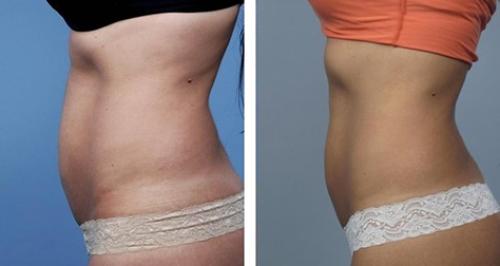 Процедуры для похудения в салоне. Показания и противопоказания к проведению аппаратной коррекции фигуры 03