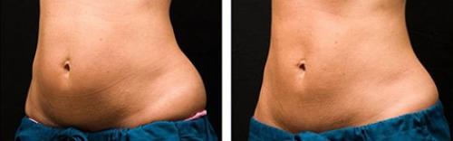 Процедуры для похудения в салоне. Показания и противопоказания к проведению аппаратной коррекции фигуры 04