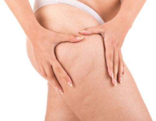 Помогают ли обертывания от целлюлита. Как избавиться от целлюлита на бедрах и ягодицах