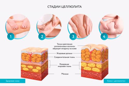 Обертывания против целлюлита в домашних условиях. Кому противопоказаны 01