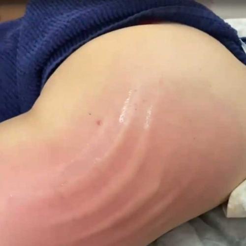 Ручная липосакция галифе. Как убрать галифе на бедрах