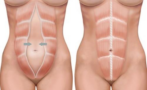 Почему у девушек выпирает низ живота и что делать. Определение болезни. Причины заболевания 03