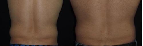 Как избавиться от жировых отложений в икрах и коленях. Как избавиться от целлюлита на животе 05 Как избавиться от жировых отложений в икрах и коленях. Как избавиться от целлюлита на животе 05