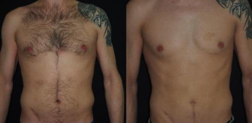 Как избавиться от жировых отложений в икрах и коленях. Как избавиться от целлюлита на животе 04 Как избавиться от жировых отложений в икрах и коленях. Как избавиться от целлюлита на животе 04