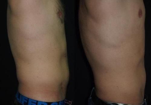 Как избавиться от жировых отложений в икрах и коленях. Как избавиться от целлюлита на животе 06 Как избавиться от жировых отложений в икрах и коленях. Как избавиться от целлюлита на животе 06