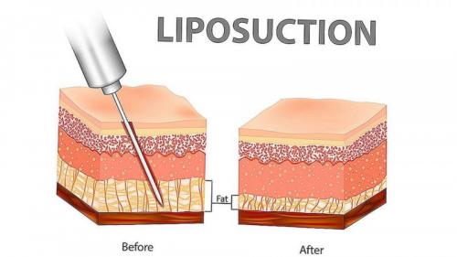 Лучшие липолитики для похудения. Насколько эффективны липолитики. Показания и противопоказания 01