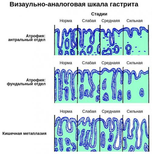 Как восстановить защитные свойства желудка.. Классификация и стадии развития атрофического гастрита 01