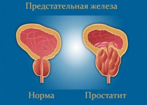 Хронический простатит: причины. Хронический простатит