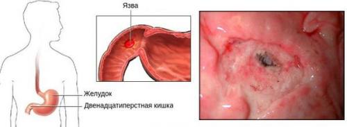 Принципы питания при язвенной болезни. Особенности режима при язве желудка 05 Принципы питания при язвенной болезни. Особенности режима при язве желудка 05