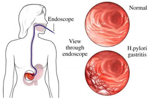 Диета при хроническом гастрите. Суточный рацион: меню на неделю 04 Диета при хроническом гастрите. Суточный рацион: меню на неделю 04