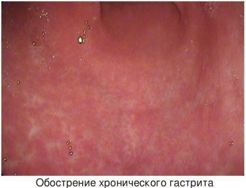 Диета при хроническом гастрите. Суточный рацион: меню на неделю 05 Диета при хроническом гастрите. Суточный рацион: меню на неделю 05
