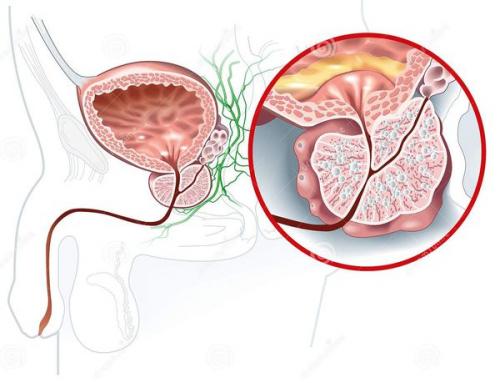 Диета при аденоме простаты. Правильно питаться (отказаться от простых углеводов) 04