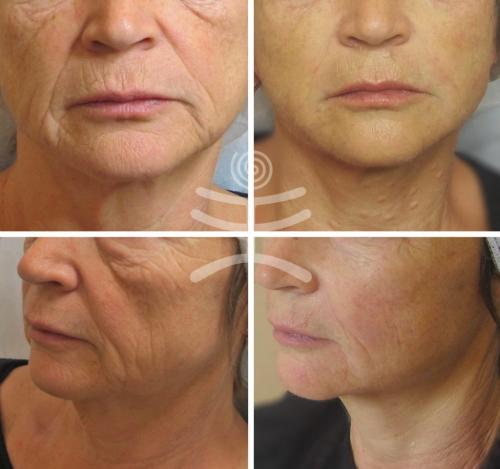 Аппаратная косметология для омоложения лица. Аппаратные процедуры